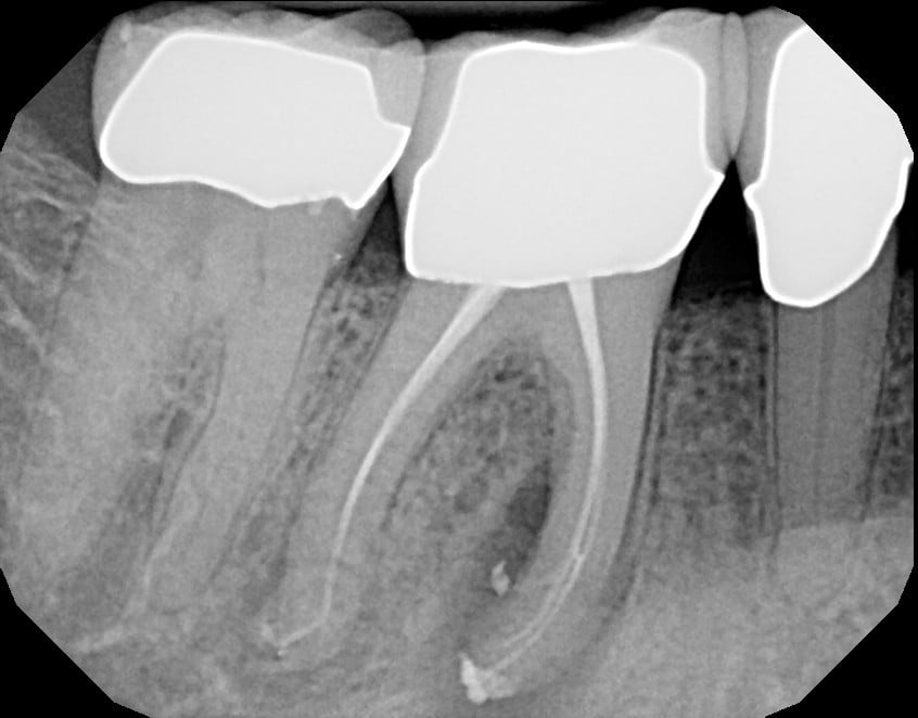 Root Canal Therapy x-ray